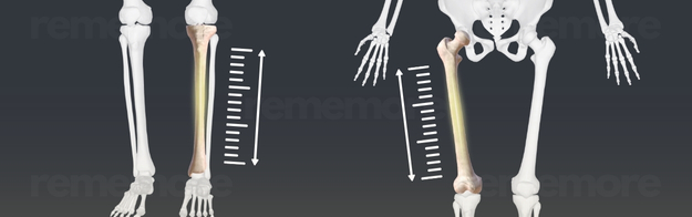 Limb Lengthening Surgery Cost in Turkey